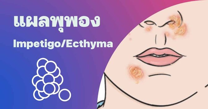 แผลพุพอง (Impetigo/Ecthyma) อาการ, สาเหตุ, การรักษา ฯลฯ