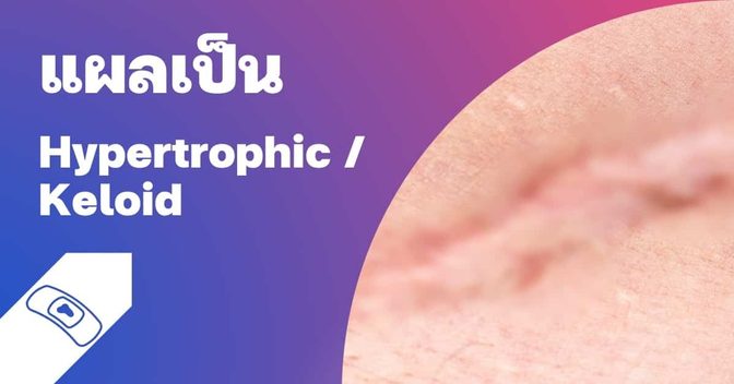 17 วิธีรักษาแผลเป็น ! วิธีลบรอยแผลเป็น & คีลอยด์ อย่างได้ผล ?