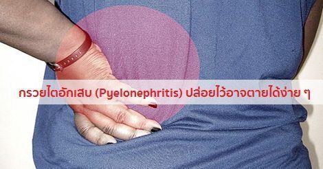 กรวยไตอักเสบ อาการ สาเหตุ การรักษาโรคกรวยไตอักเสบ 7 วิธี !!