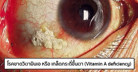 การรักษาโรคขาดวิตามินเอ (Vitamin A deficiency) & วิธีป้องกัน 5 วิธี !