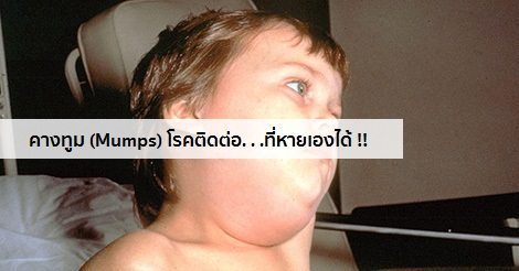 คางทูม อาการ สาเหตุ และการรักษาโรคคางทูม 13 วิธี !!