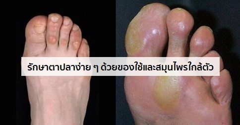 ตาปลา อาการ สาเหตุ และการรักษาโรคตาปลา 29 วิธี !!