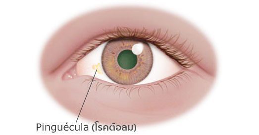 ต้อลม (Pinguecula) อาการ สาเหตุ และการรักษาโรคต้อลม 6 วิธี !!