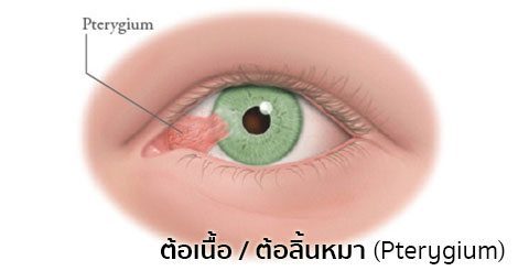 ต้อเนื้อ (Pterygium) อาการ, สาเหตุ, การรักษาโรคต้อเนื้อ ฯลฯ