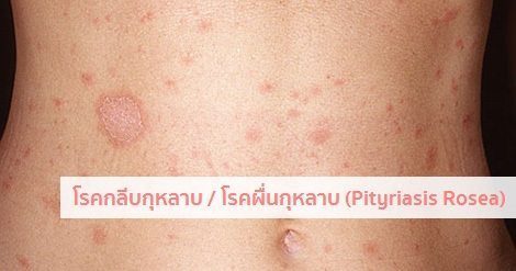 ผื่นกุหลาบ อาการ สาเหตุ และการรักษาโรคผื่นกลีบกุหลาบ 5 วิธี !!
