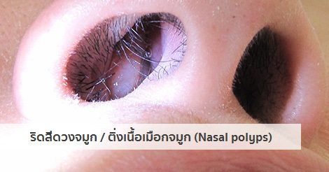 ริดสีดวงจมูก อาการ สาเหตุ และการรักษาโรคริดสีดวงจมูก 6 วิธี !!