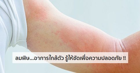 ลมพิษ อาการ สาเหตุ และการรักษาโรคลมพิษ 11 วิธี !!