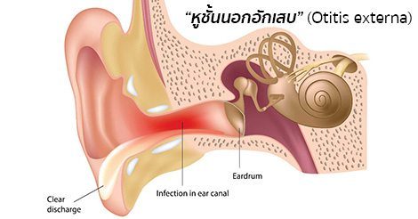 หูชั้นนอกอักเสบ อาการ สาเหตุ และการรักษาโรคหูชั้นนอกอักเสบ 5 วิธี !!