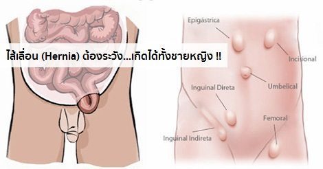 ไส้เลื่อน อาการ สาเหตุ และการรักษาโรคไส้เลื่อน 7 วิธี !!