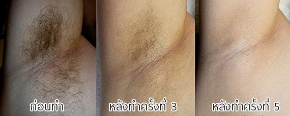 ไดโอดเลเซอร์