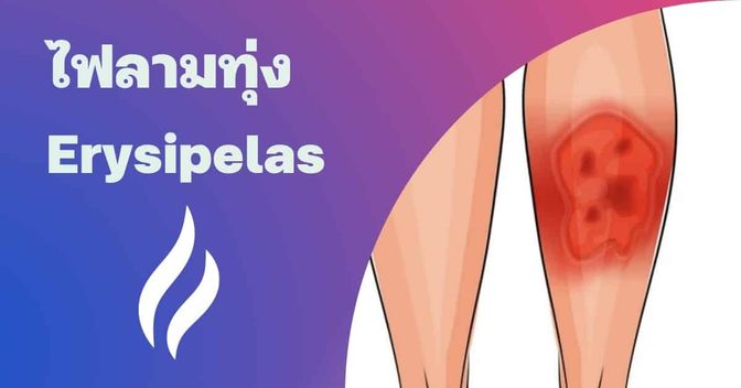 ไฟลามทุ่ง (Erysipelas) อาการ, สาเหตุ, การรักษา ฯลฯ