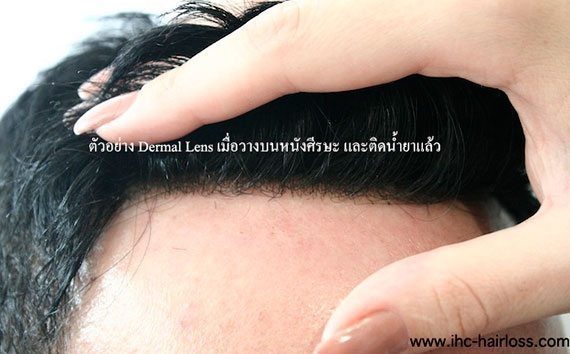 ปลูกผมแบบใหม่โดยไม่ต้องผ่าตัด