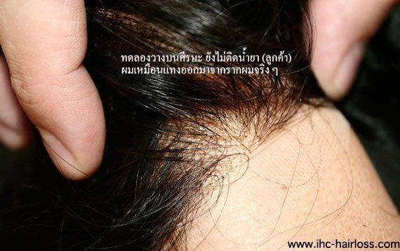 ปลูกผมแบบใหม่โดยไม่ต้องผ่าตัด