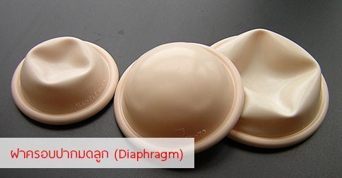 14 ข้อดี-ข้อเสีย & วิธีใส่ฝาครอบปากมดลูก ! (Diaphragm)