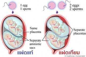 ตั้งครรภ์แฝด