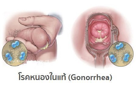 โรคหนองในแท้