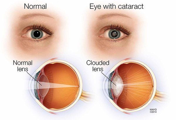 ต อกระจก Cataract อาการ สาเหต และการร กษาโรคต อกระจก 12 ว ธ