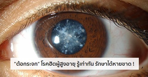 ต อกระจก Cataract อาการ สาเหต และการร กษาโรคต อกระจก 12 ว ธ