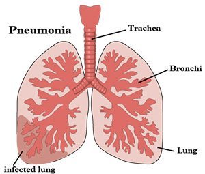 pneumonia คือ