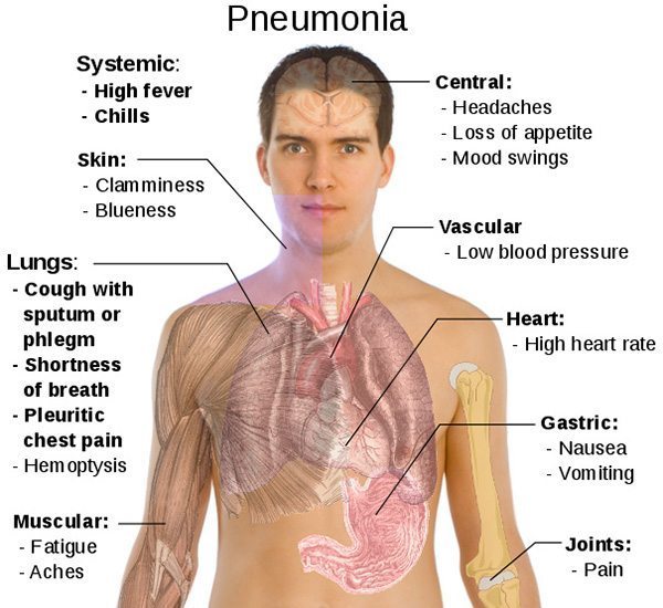 pneumonia พยาธิสภาพ