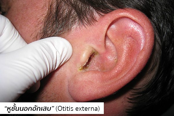 หูชั้นนอกอักเสบ อาการ สาเหตุ และการรักษาโรคหูชั้นนอกอักเสบ 5 วิธี !!