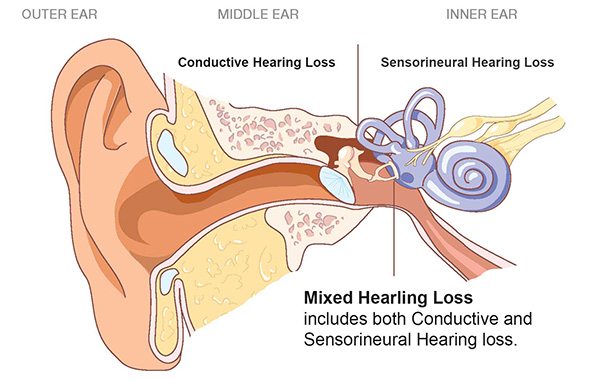 การสูญเสียการได้ยิน