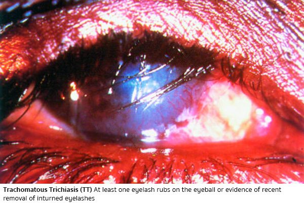 ริดสีดวงตาระดับ 4 (Trachomatous Trichiasis - TT)