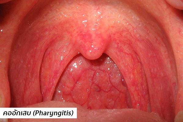 คออักเสบ (Pharyngitis)