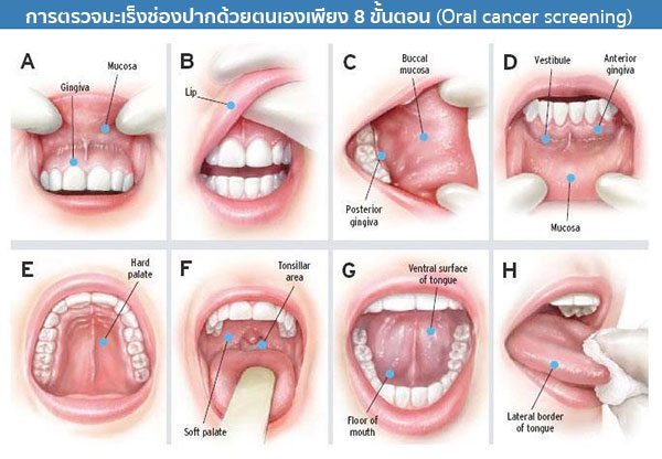 การตรวจมะเร็งช่องปาก