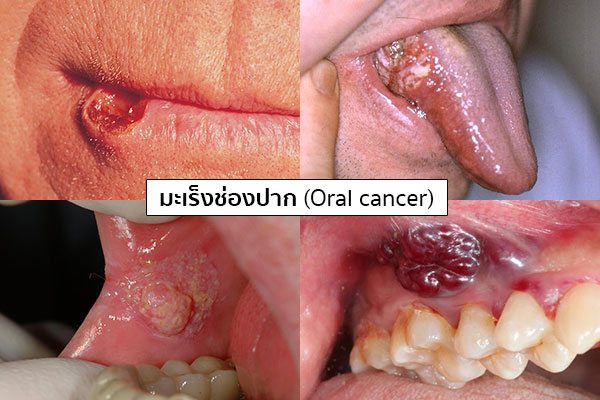 มะเร็งในช่องปากอาการ