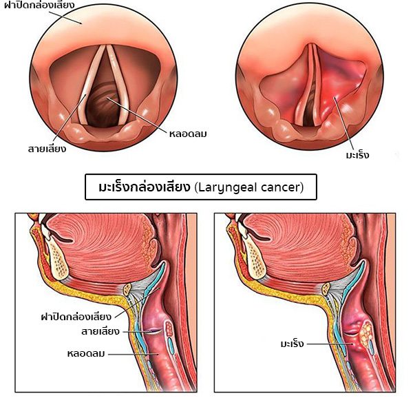 มะเร็งกล่องเสียงอาการ