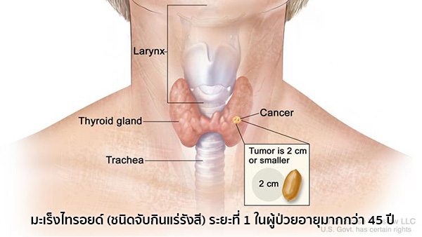 มะเร็งต่อมไทรอยด์ระยะที่1