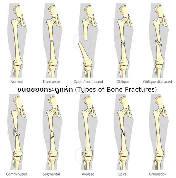 กระดูกหัก (Bone fracture) 