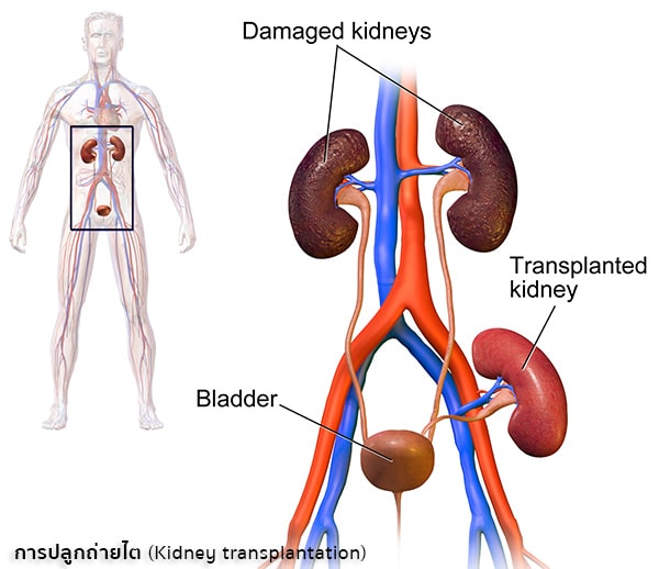 การรักษาภาวะไตวายด้วยการปลูกถ่ายไต (Kidney transplantation)