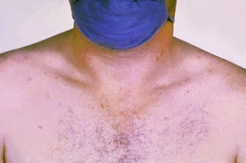 IMAGE SOURCE : en.wikipedia.org (by CDC)