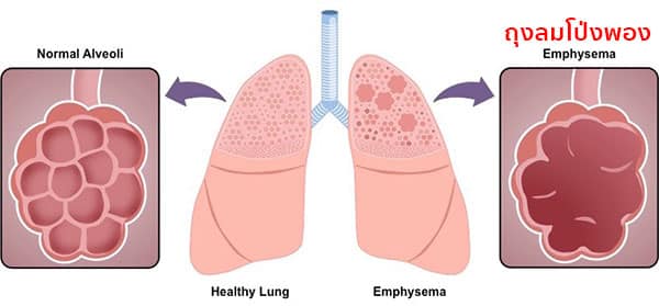 Emphysema คืออะไร