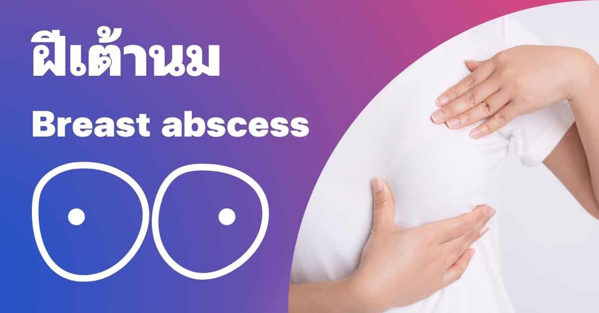 ฝีเต้านม (Breast abscess) อาการ, สาเหตุ, การรักษา ฯลฯ
