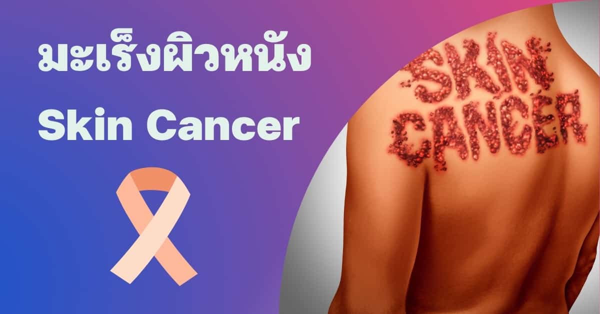 มะเร็งผิวหนัง (Skin cancer) อาการ, สาเหตุ, การรักษา ฯลฯ