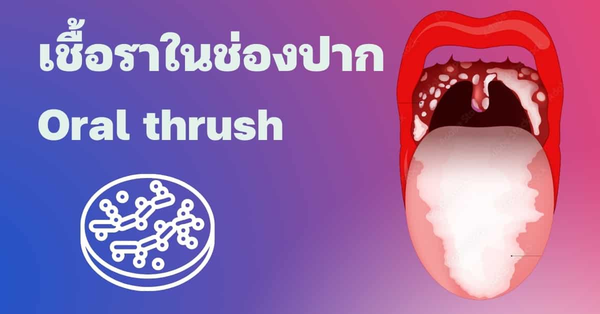 เชื้อราในปาก (Oral thrush) อาการ, สาเหตุ, การรักษา ฯลฯ