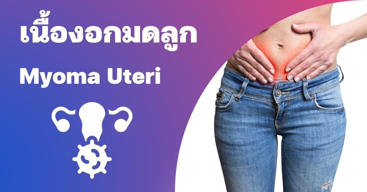 เนื้องอกมดลูก (Myoma uteri) อาการ, สาเหตุ, การรักษา ฯลฯ