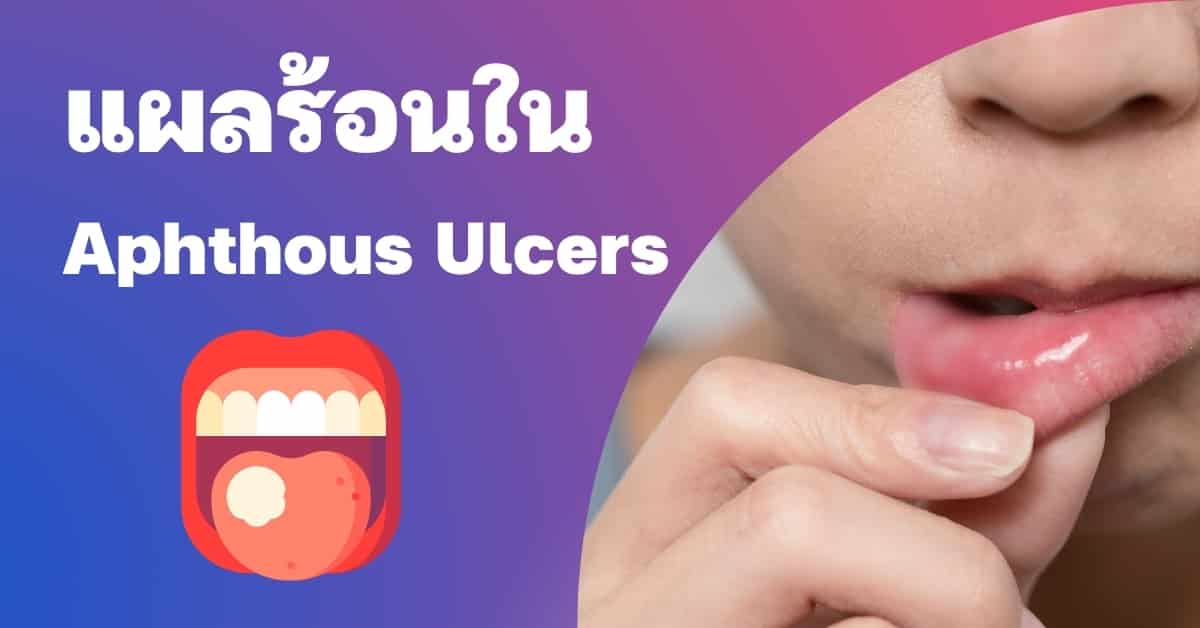 ร้อนใน (Aphthous Ulcer) อาการ, สาเหตุ, การรักษาแผลร้อนใน ฯลฯ