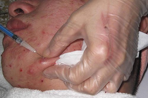 ฉีดสิวอักเสบ