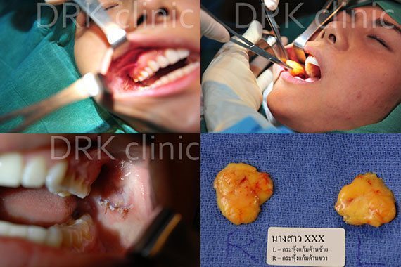 ผ่าตัดลดแก้ม