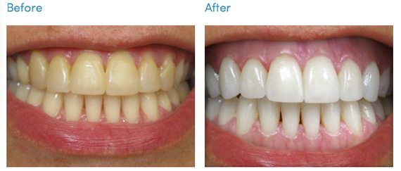 25 วิธีทำให้ฟันขาว ฟันเหลืองทำไงดี ??