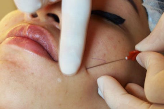 ร้อยไหมลดแก้ม