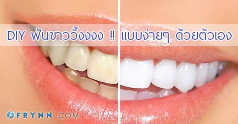 25 วิธีทำให้ฟันขาว ฟันเหลืองทำไงดี ??