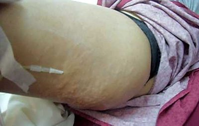 ฉีดคาร์บ็อกซี่