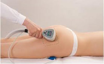 RF ลดสะโพก