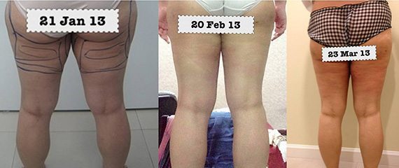 Vaser ลดสะโพก