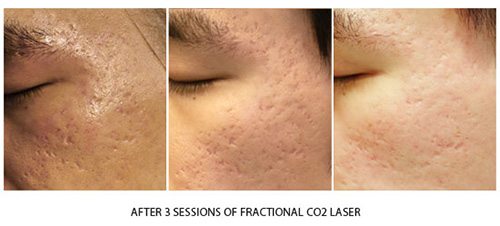 เลเซอร์-Fractional-CO2